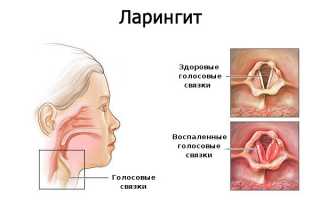 Как эффективно лечить пропавший голос с кашлем