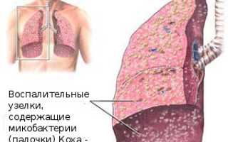 Как избежать заражения туберкулезом
