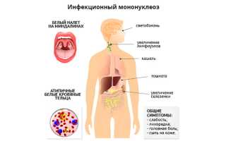 Мононуклеоз у ребенка