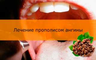 Лечение ангины прополисом