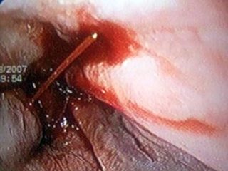 Болит со стороны спины за ребрами