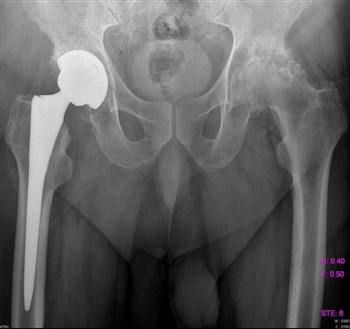 Может ли болеть в паху от спины