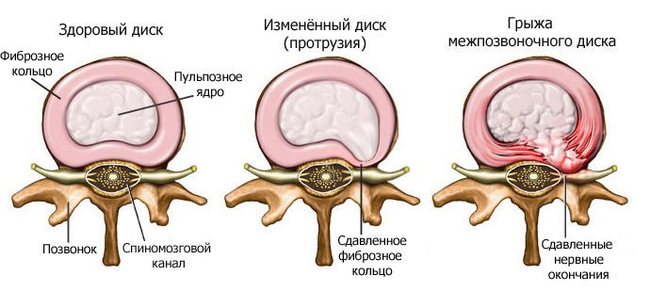 К какому врачу обратиться если болит спина между лопатками