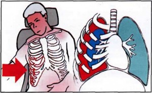 От ушиба грудной клетки болит спина