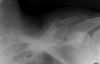 Болит ключица за спиной