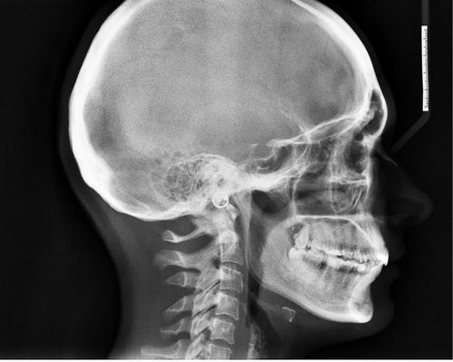 Когда лежу голова не болит встаю болит