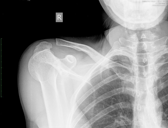 Болит ключица за спиной