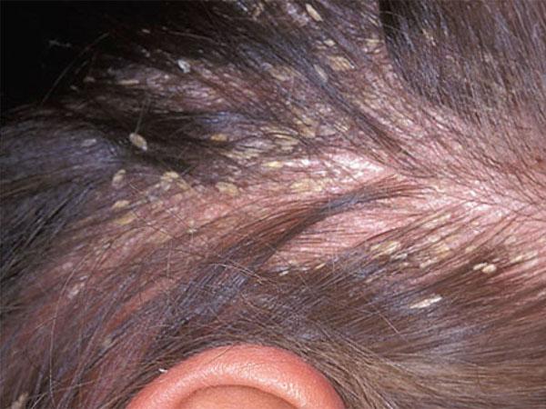 мокнет голова и болит