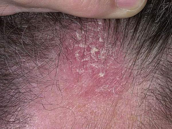 мокнет голова и болит