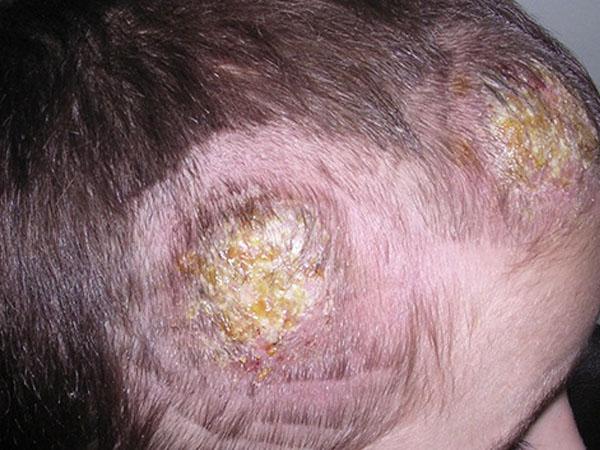 мокнет голова и болит