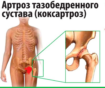Артроз тазобедренного сустава