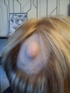 Новообразования мягких тканей и кости Новообразования мягких тканей и кости