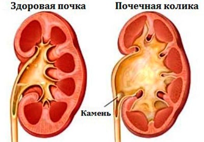 Почечная колика