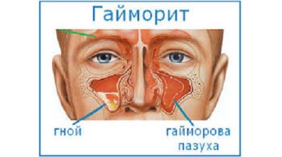 Температура несколько дней и болит спина