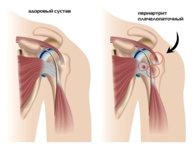 Болит спина в области лопатки отдает в руку