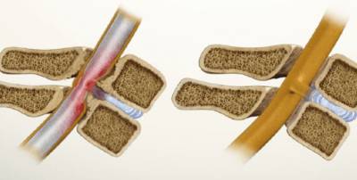 Может ли болеть в паху от спины