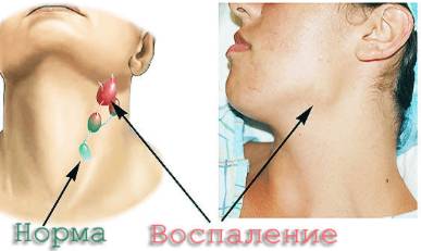Температура несколько дней и болит спина