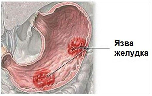 Язва желудка