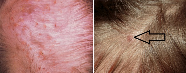 Фолликулит на голове