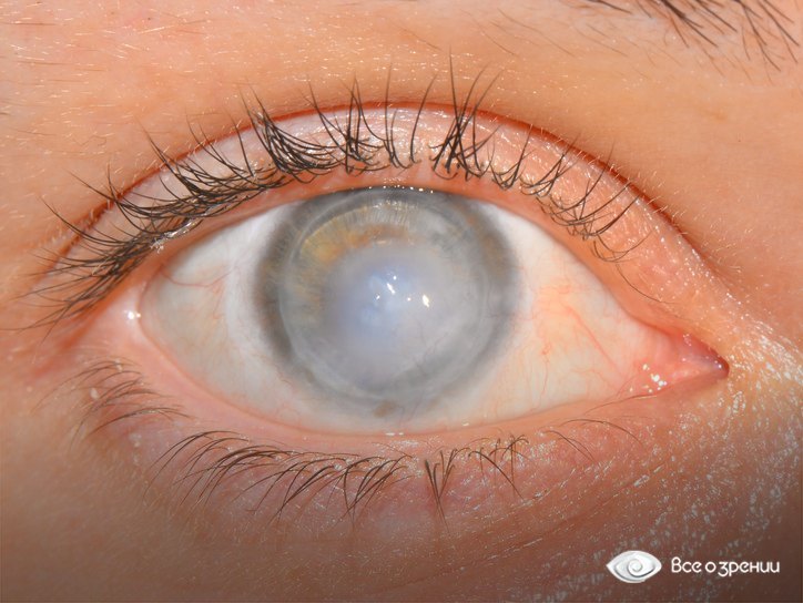 помутнение на роговице pomutnenie-rogovicy.jpg