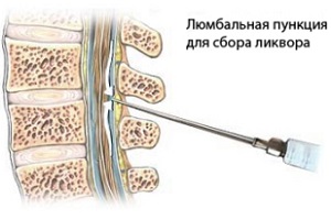 Любмальная пункция Любмальная пункция