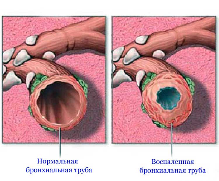 Воспаление бронхиальной трубы